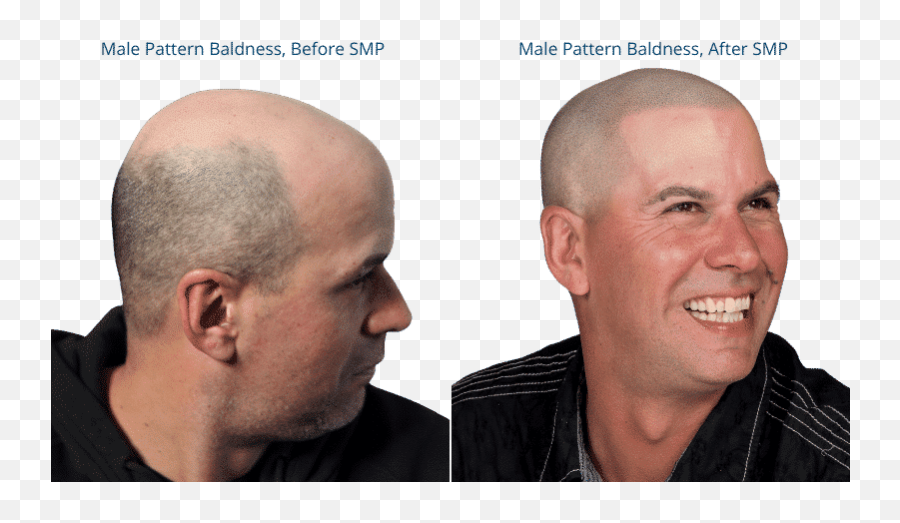 Scalp Micropigmentation For Male Pattern Baldness Smp For Emoji,Hair Quivers With Emotion