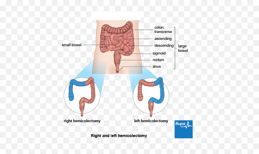 Bowel Surgery - Large Bowel Resection Emoji,How Your Emotions Affect Your Body Organs