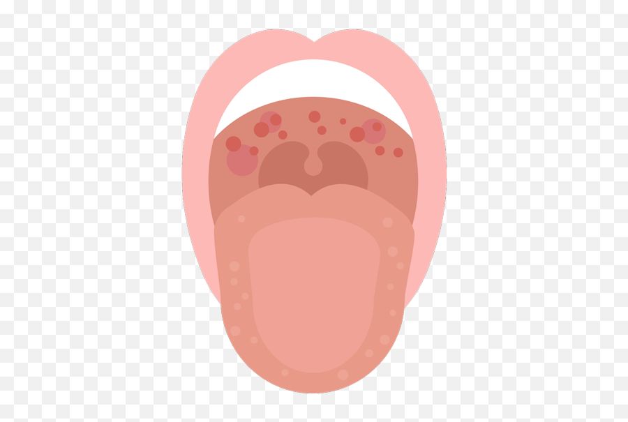 Red Spots In The Mouth How To Treat Red Spots On Roof Of Mouth - Red Spot On Throat Emoji,Fushia Pink Emotion