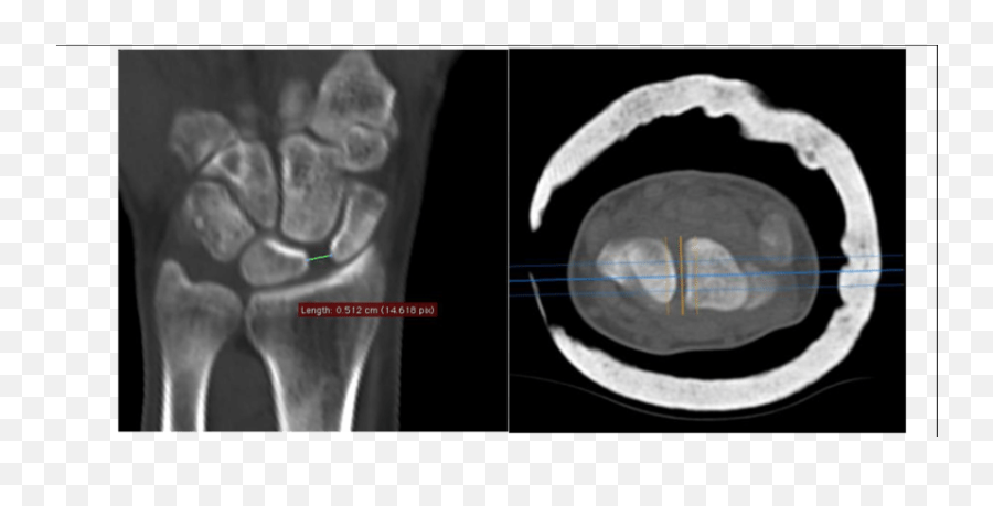 Coronal Plane - Computed Tomography Emoji,Xrs Emotion 16 Siemens