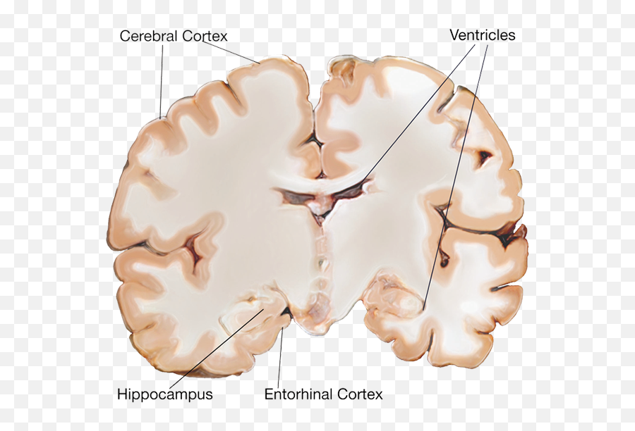 The Quiet Creep Of Alzheimeru0027s Disease Emoji,The Limbic System Structure That Is Especially Involved In Emotion Is The