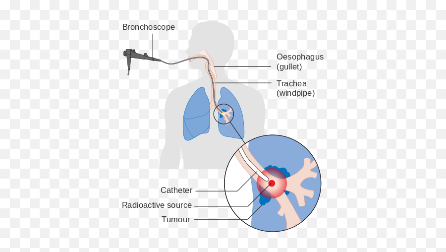 Lung Cancer - Wikiwand Internal Radiation Therapy Diagram Emoji,Advan Emotion Test Pipe S13