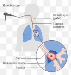Lung Cancer - Wikiwand Internal Radiation Therapy Diagram Emoji,Advan Emotion Test Pipe S13