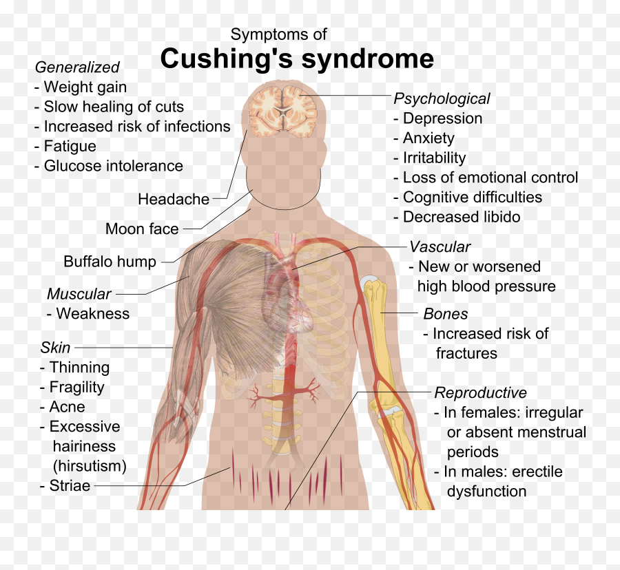 Glucocorticoidpharmacology Tusom Pharmwiki - Features Of Cushing Syndrome Emoji,Effects Of Full Moon On Emotions