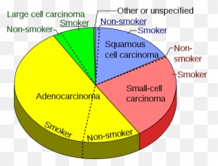 Lung Cancer - Wikiwand Lung Cancer Pie Charts Emoji,Advan Emotion Test Pipe S13