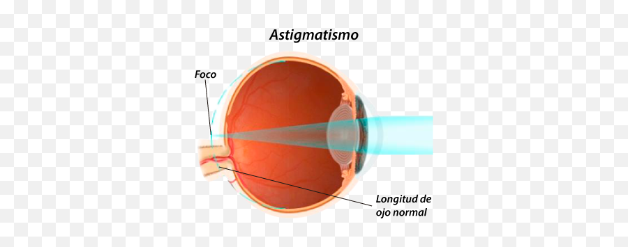 Salud Visual 3 La Hipermetropia - Hypermetropia And Acute Angle Closure Glaucoma Emoji,Ojos Bizcos Emoticon