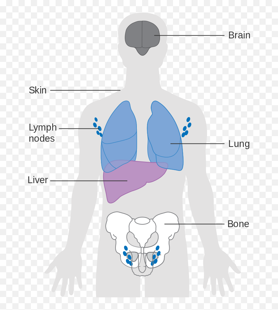 Diagram Skin Cancer Diagrams Body Map Full Version Hd - Common Places Melanoma Found Emoji,350z Emotion Cr2p