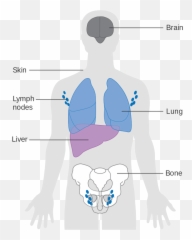 Diagram Skin Cancer Diagrams Body Map Full Version Hd - Common Places Melanoma Found Emoji,350z Emotion Cr2p