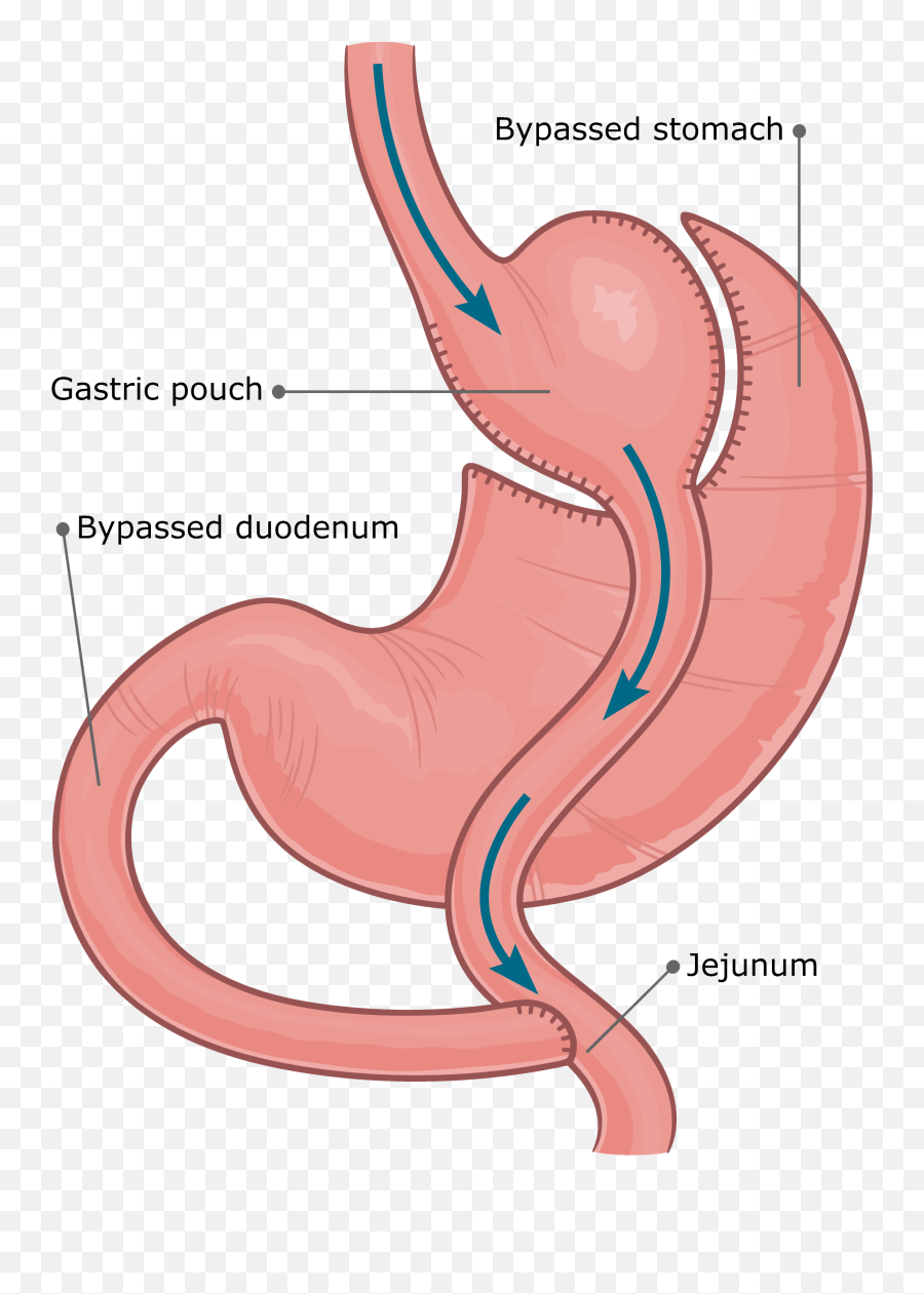 Frequently Asked Questions About Bariatric Surgery - Gastric Bypass Emoji,Emotions Of Pdiatric Surgeon