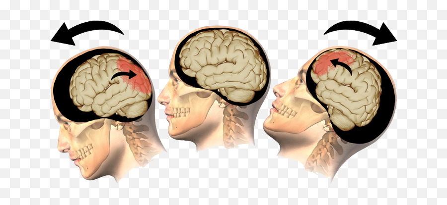 Understanding Tbi - Traumatic Brain Injury Acceleration Emoji,Meningioma Affects Areas Of Brain Right Occipital Emotions