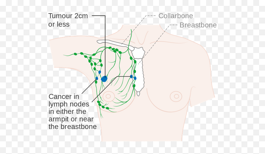 Breast Cancer - Stage 3 Breast Cancer Emoji,What Emoji Represents Boobs
