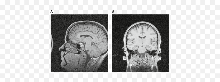 An Overview Of Functional Magnetic Resonance Imaging Part I - Computed Tomography Emoji,Our Culture Has Restricted Emotions Never South Of Skull Heaps Of Cemicals In Spinal Cord