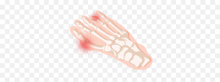 Identifying Your Foot Pain 2021 - Illustration Emoji,Ring.finger Pain Emotion