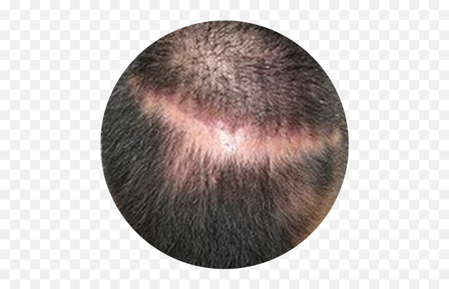 Patchy Hair Loss - Terra Medical Clinic Singapore Hair Loss Emoji,Hair Trembles With Emotion Dr