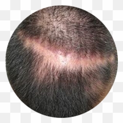 Patchy Hair Loss - Terra Medical Clinic Singapore Hair Loss Emoji,Hair Trembles With Emotion Dr