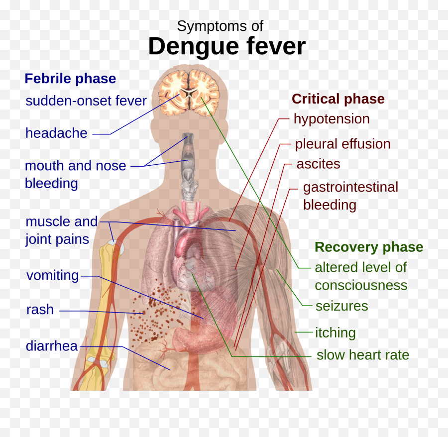 Epiphanies From A 35 - Symptoms Of Dengue Hemorrhagic Fever Emoji,Emotion Momentd Effusion Lamp