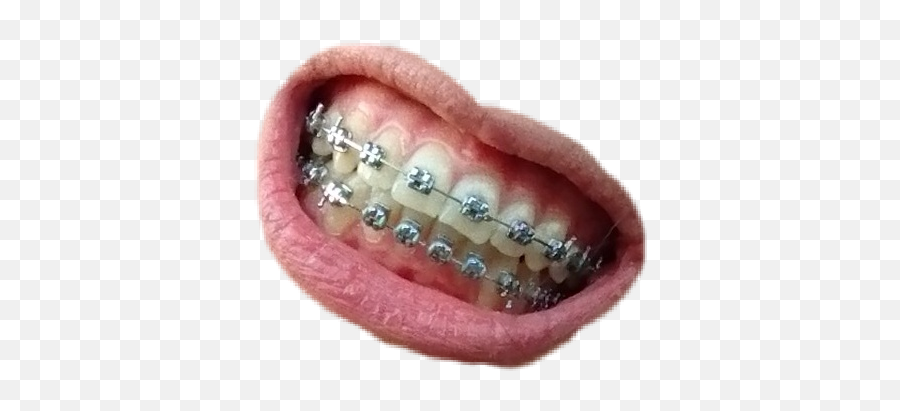 Braces Teeth Lips Sticker - Oral Hygiene Emoji,Pics Of Emoji Teeth With Braces