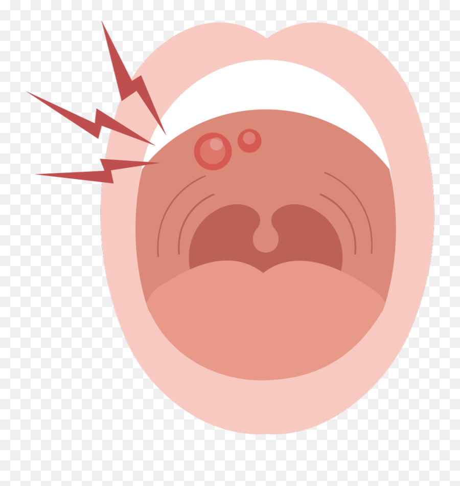 Painful Mouth Sore Symptoms Causes - Mouth Ulcer Cartoon Png Emoji,7 Up Spot Emotion Icons