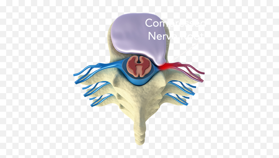 Radiculopathy Pinched Nerve Treatments - Hernie Cervicale Nevralgie Cervico Brachiale Emoji,Emotion Trap In The Spine