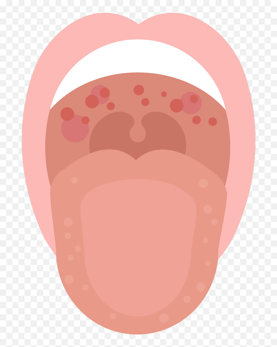 Red Spots In The Mouth - Red Spots On Roof Of Mouth Emoji,I Am Used To Carring My Emotions Inside