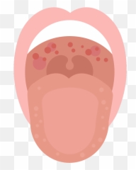 Red Spots In The Mouth - Red Spots On Roof Of Mouth Emoji,I Am Used To Carring My Emotions Inside