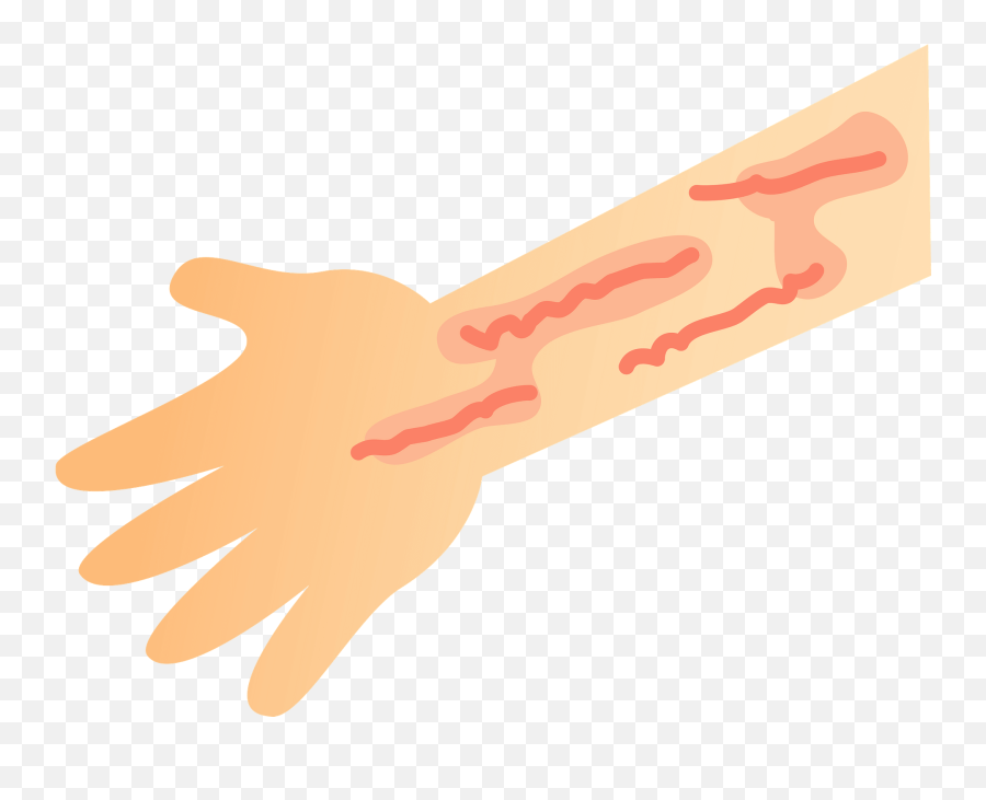 Dermatitis - Skin Rash On The Arm Clipart Free Download Skin Rash Clipart Png Emoji,Muscle Arm Emoji
