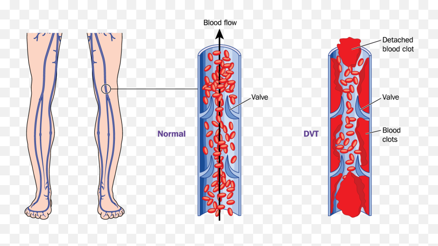 Agency For Services To Medical Science - Deep Vein Thrombosis Emoji,Raw Emotions After Blood Clot