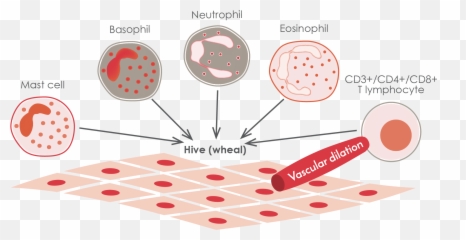 Disease Overview - Epidemiology Of Urticaria Hd Emoji,Weal With Emotion