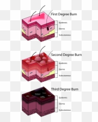 Burn - Wikiwand Nursing Classification Of Burns Emoji,Papyrus Emotion Chart