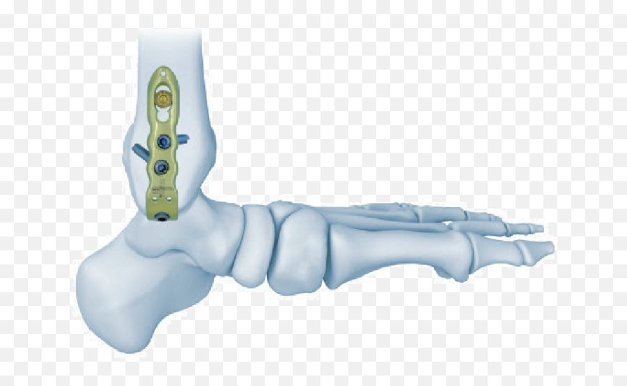 Distal Medial Tibial Locking Platemedical Device U0026 Implants Emoji,Tibia Emoji