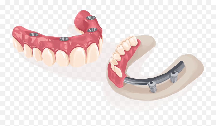 G4 By Golpa Author At G4 - Dental Implants Emoji,Two Front Teeth Missing Emojis