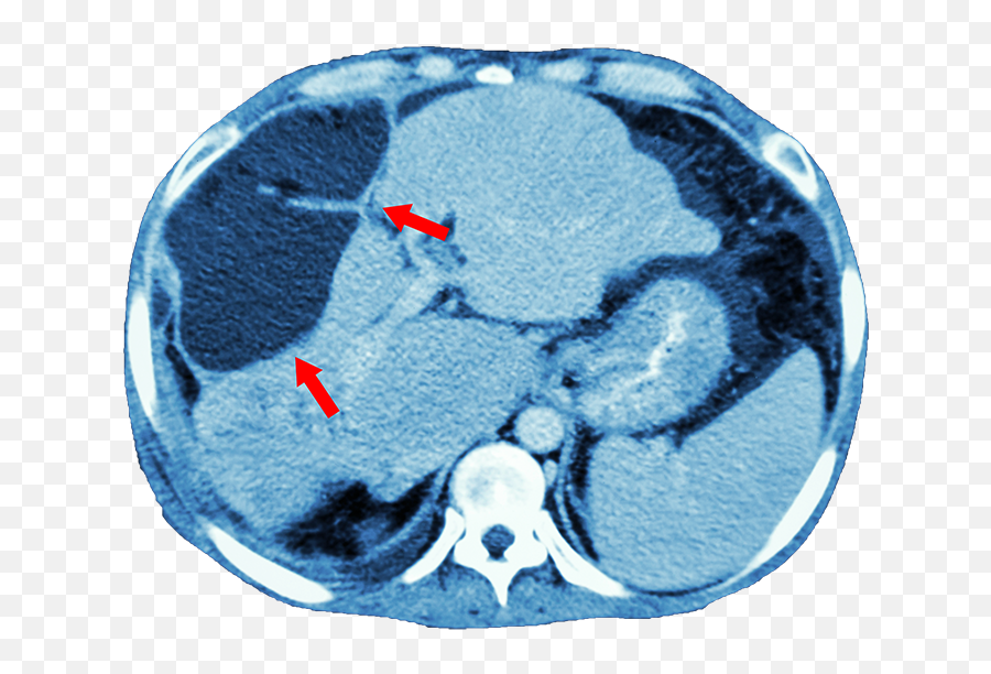 Kidney Pancreas Transplant Emoji,Emotions Spleen Pancreas