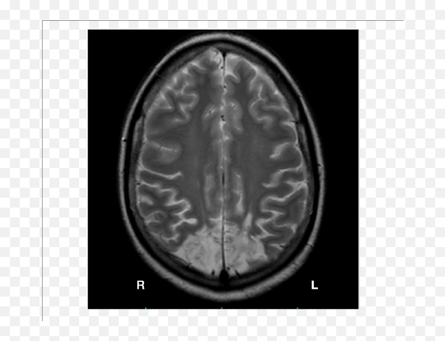 Brain Mri Of Gp Bilateral Lesion Of The - Bilateral Parietal Occipital Lesions Emoji,Emotions In Brain Scans