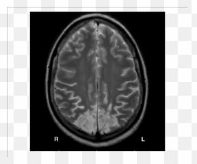 Brain Mri Of Gp Bilateral Lesion Of The - Bilateral Parietal Occipital Lesions Emoji,Emotions In Brain Scans