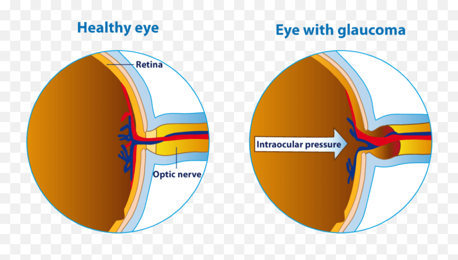Vision Disability Types And Information Disabled World - Glaucoma Treatment Emoji,Emotions Through Eyes