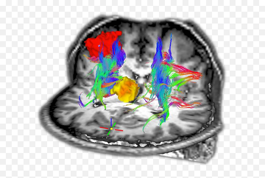 New Findings Of Reduced Thalamo - Frontal Connectivity In Drawing Emoji,Schizophrenia & Emotions