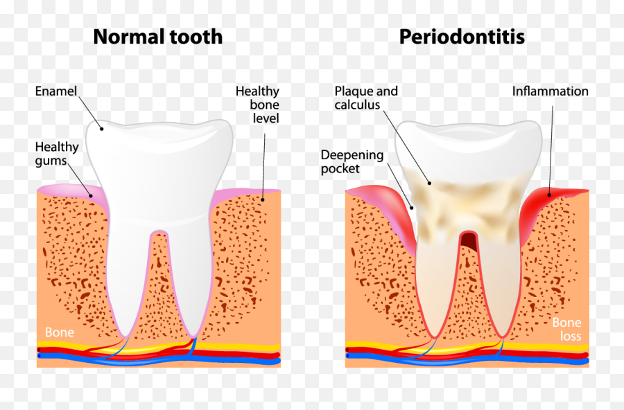 Periodontal Therapy Eastlake Center Emoji,Gums And Emotions Chart