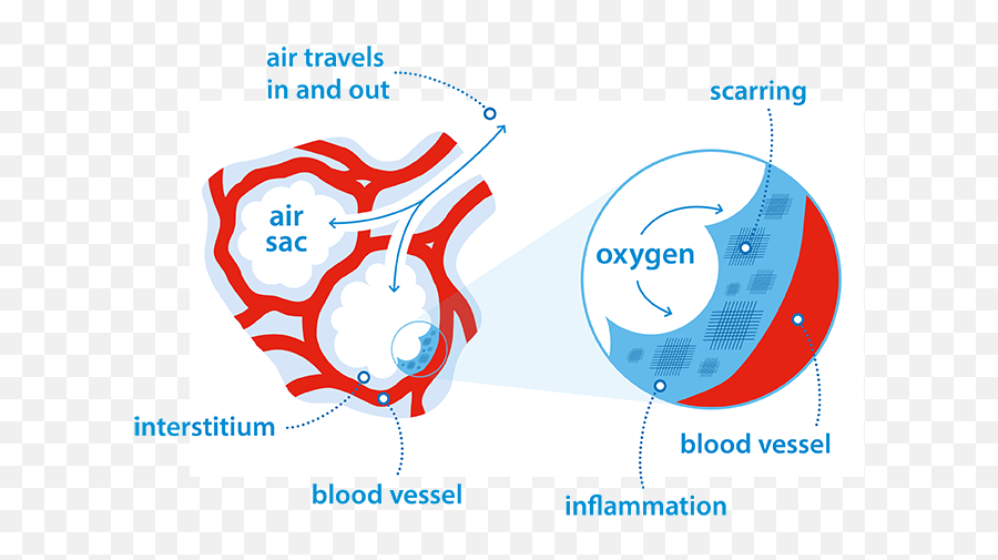 How Does Pulmonary Fibrosis Affect Your Breathing British Emoji,Warm Blood Emotion