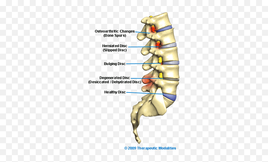 Holistic Spinal Stenosis Treatment Without Spine Surgery Emoji,Spinal Misalignments And Emotions