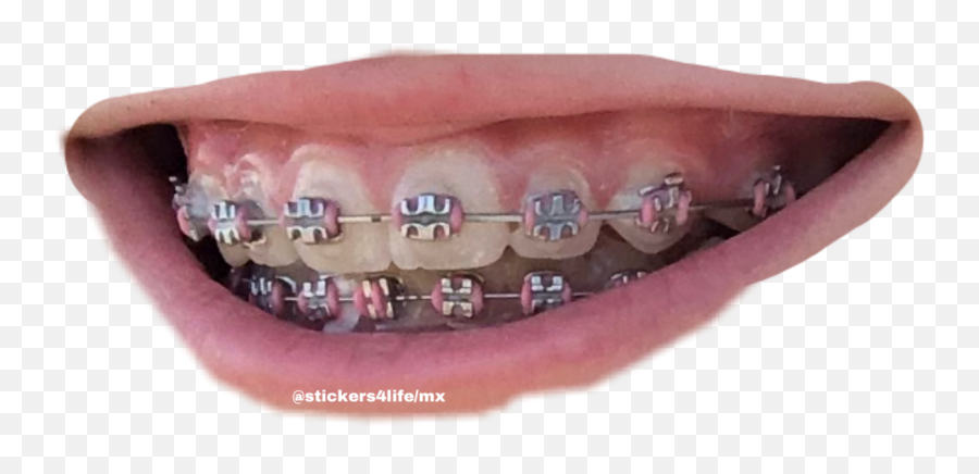 Brackets Pinkbrackets Sticker - Oral Hygiene Emoji,Pics Of Emoji Teeth With Braces