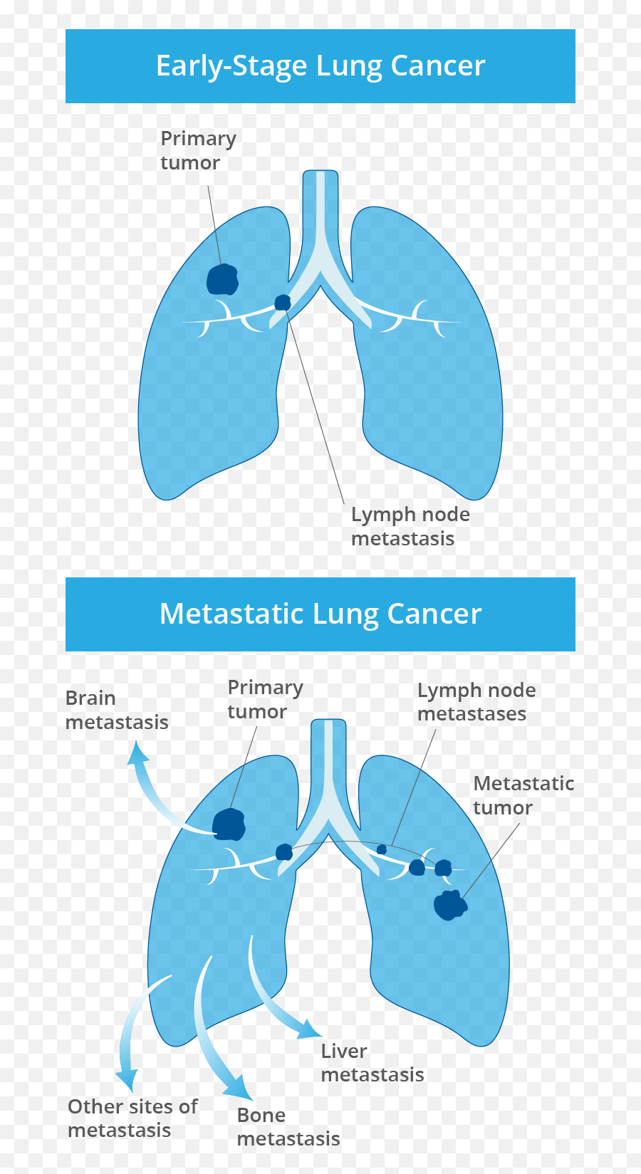 What Is Advanced Non - Small Cell Lung Cancer Nsclc Non Small Cell Lung Cancer Emoji,Liver And Emotions