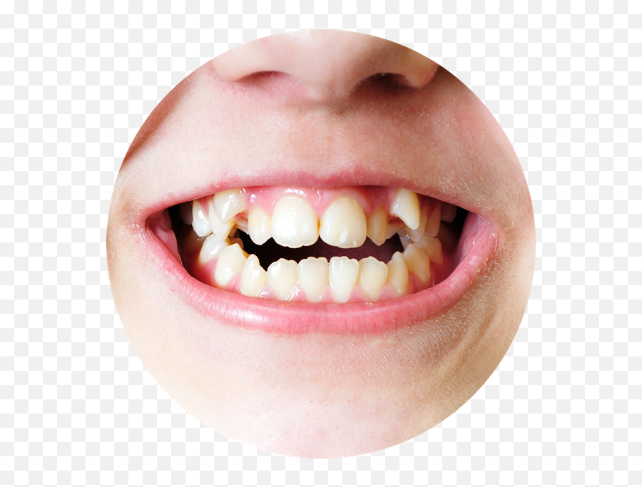 Have You Ever Been Told You Couldnu0027t Do Something Because Of - My Teeth Crooked Emoji,Happily Surprised Emoticon Smushed