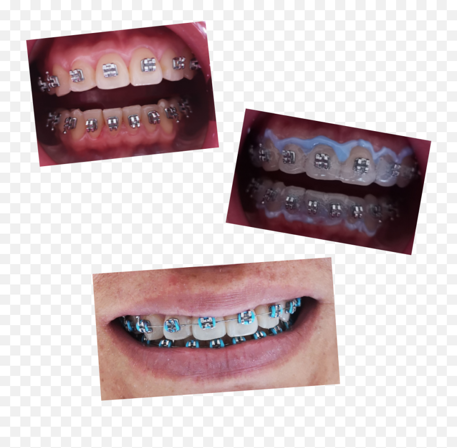 Brackets Sticker By Maite2490 - Oral Hygiene Emoji,Pics Of Emoji Teeth With Braces