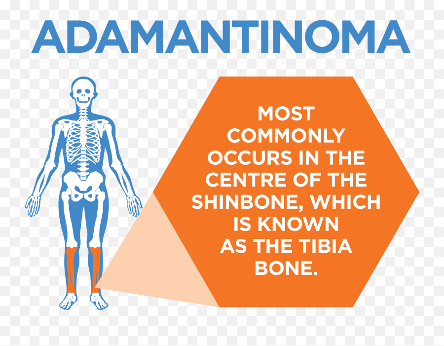 Adamantinoma - Adamantinoma Cancer Emoji,How Do You Show The Emotion Spells For Tibia