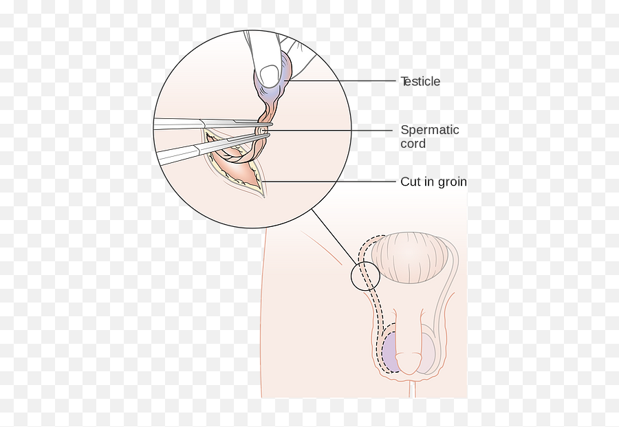 Testicular Cancer - Ilioinguinal Nerve In Inguinal Orchidectomy Emoji,Testicle Trapped Emotion