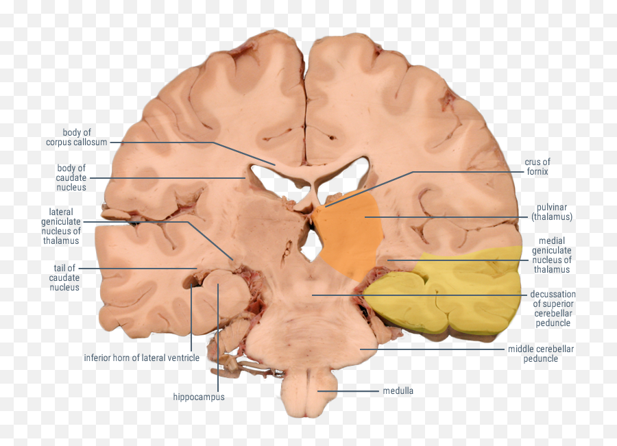 Posterior Cerebral Artery Emoji,Emoticons Center In Medulla Posterior Cerebral Artery Emoji,Emoticons Center In Medulla