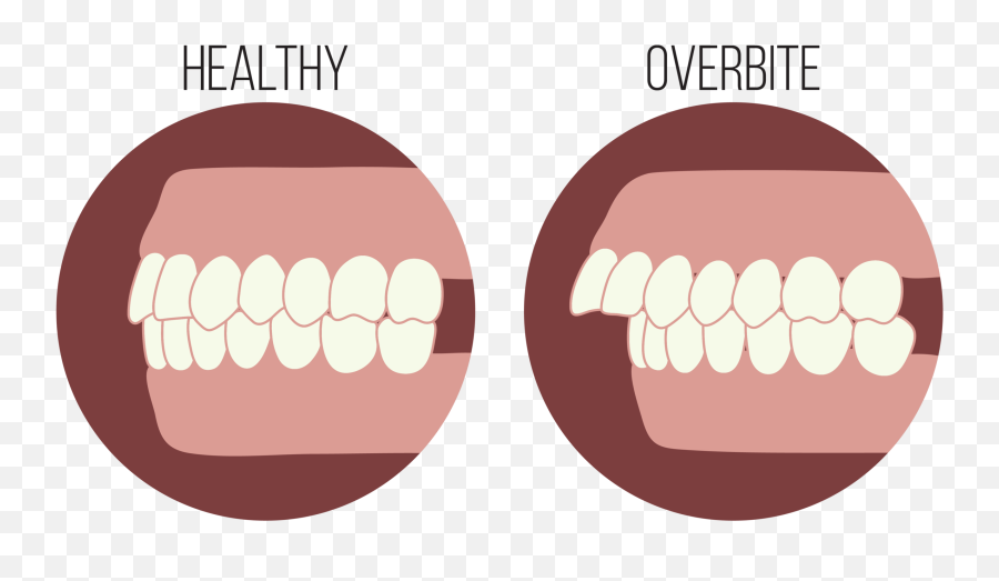Overbite Or Buck Teeth The Steps To The Smile Youu0027ve - Overbite Teeth Emoji,Smile -emoticon -smiley
