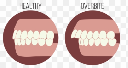 Overbite Or Buck Teeth The Steps To The Smile Youu0027ve - Overbite Teeth Emoji,Smile -emoticon -smiley