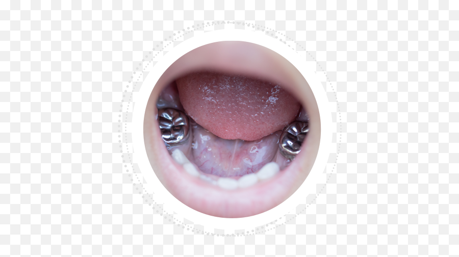 Silver And Tooth Coloured Teeth Caps Emoji,Teeth Grinding Emotion Code