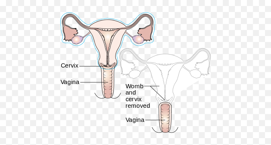 Hysterectomy Spanish Meaning Of Hysterectomy Emoji,After A Hysterectomy Will My Emotions Be Goofy